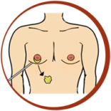 Gland Removal + Liposuction