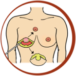 Gland Removal + Skin Lift
