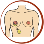 Gland Removal