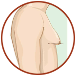 Grade 3 + Skin Lift
