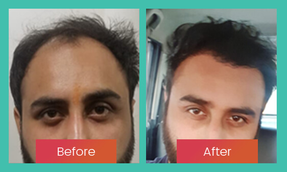 Before After 1