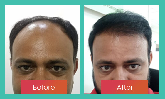 Before After 2