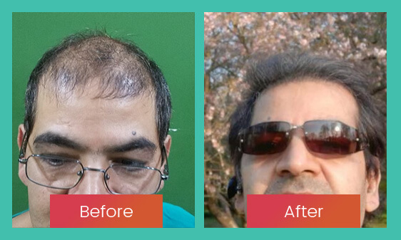 Before After 4