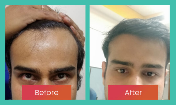 Before After 3