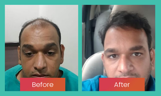 Before After 5