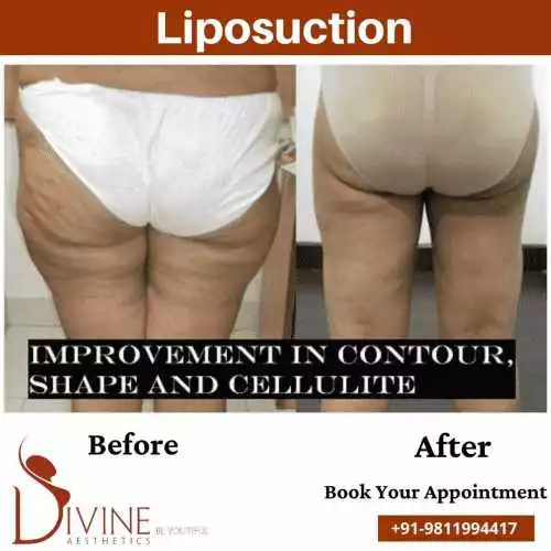 Back thigh Liposuction before after