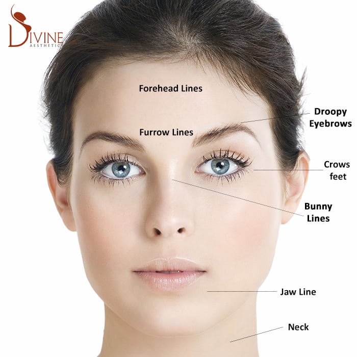 botox injection in Delhi, Botox and Dermal Fillers