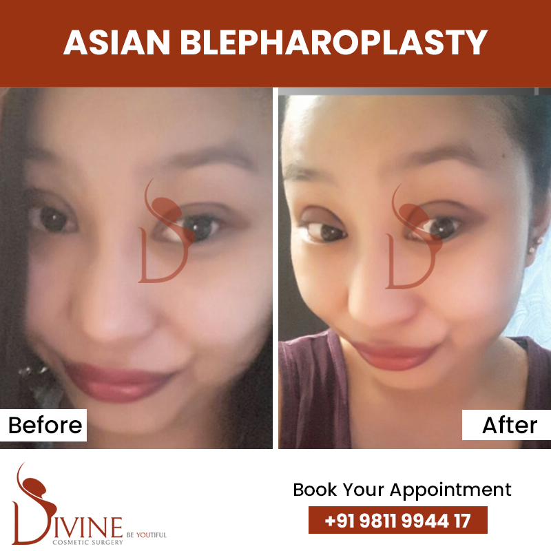 asian blepharoplasty