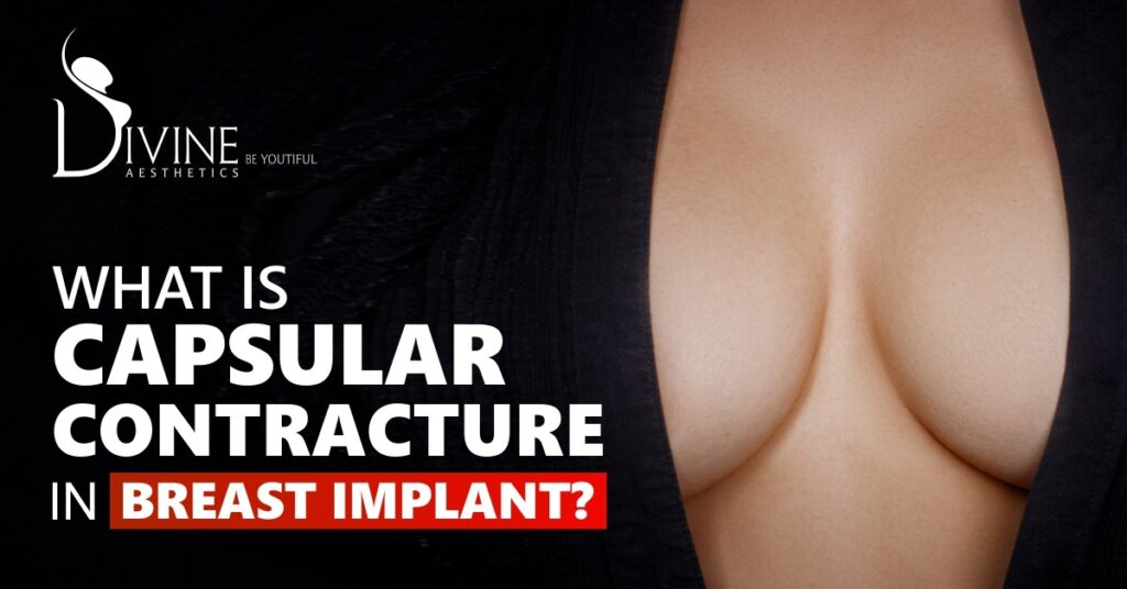 Capsular Contracture in Breast Implant