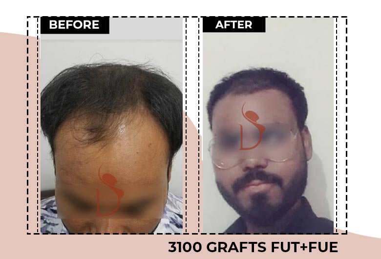 Long hair transplantation in delhi