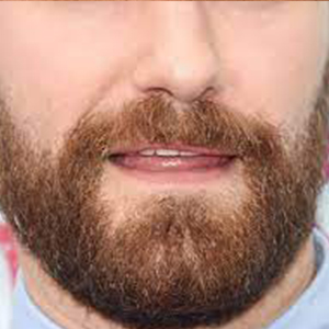 Beard hair transplants use your natural hair which gives you natural-looking results.