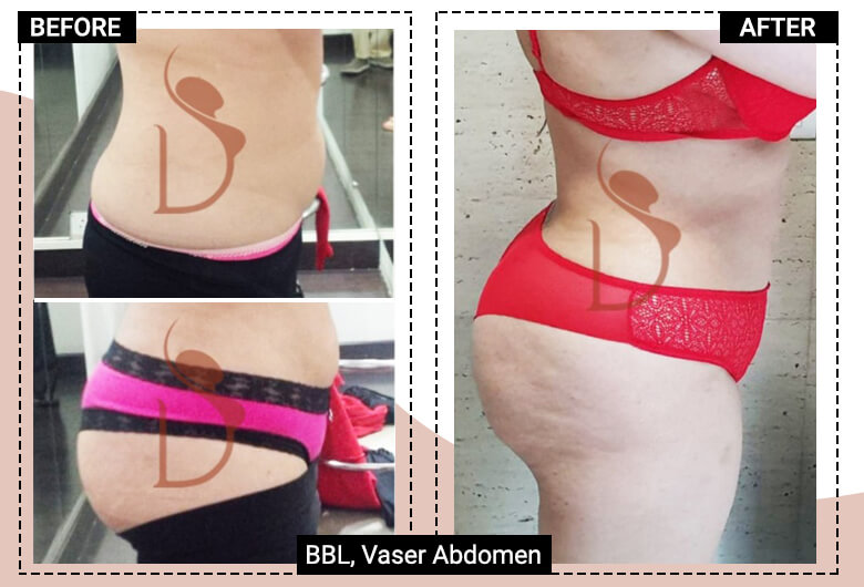 Brazilian Butt Lift with Divine Cosmetic1