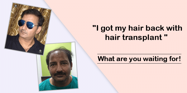 Cost of Direct Hair Transplant