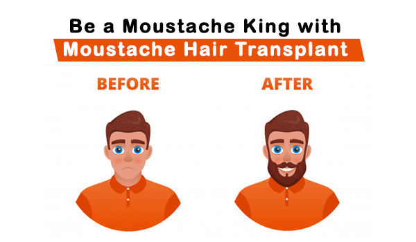 Cost of Moustache Hair Transplant