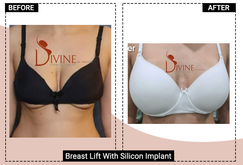affordable breast lift surgery in delhi india