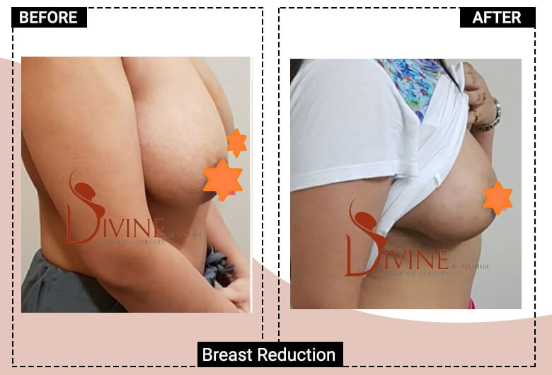 best breast reduction surgeon delhi