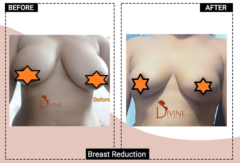 best female breast reduction cost in india