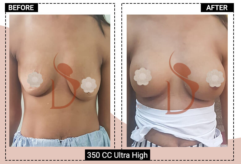 breast augmentation cost in india (2)