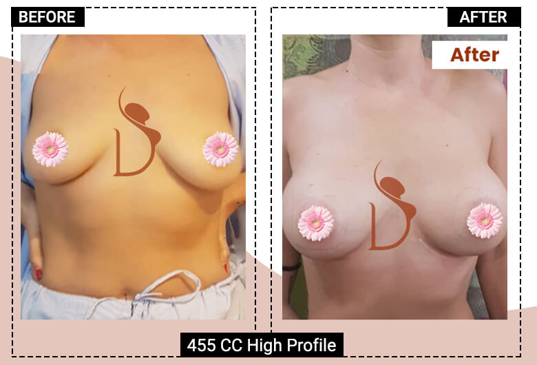 breast enlargement surgery in delhi