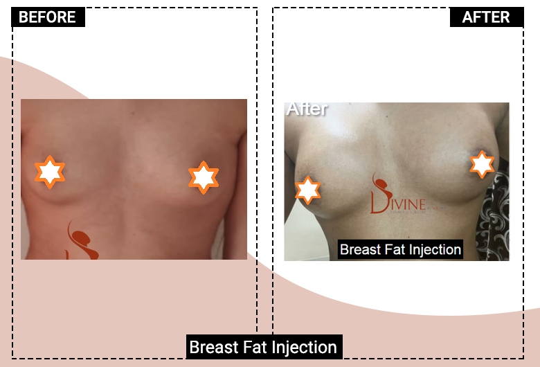 breast fat injecion india