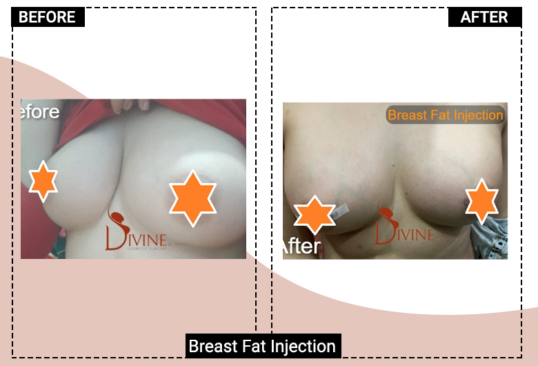 breast fat injection delhi