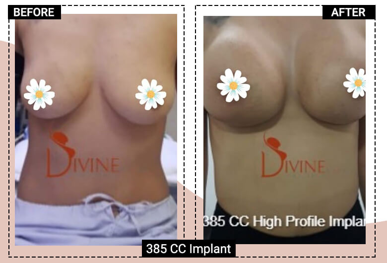 breast implants augmentation surgery cost in india