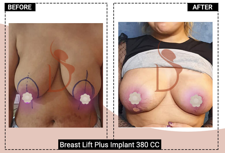 breast lift surgery delhi india