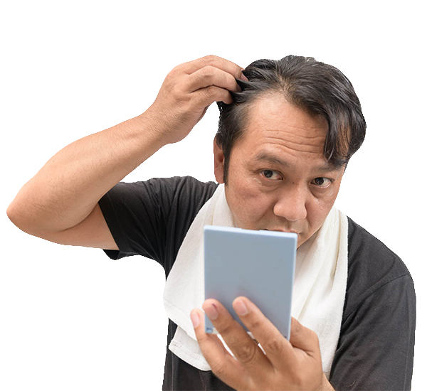 hair loss for male in delhi
