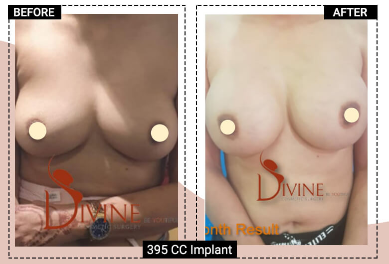 silicone breast implant surgery cost in india