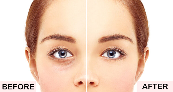 All You Need To Know About Lower Eye Bag Removal  Woffles Wu