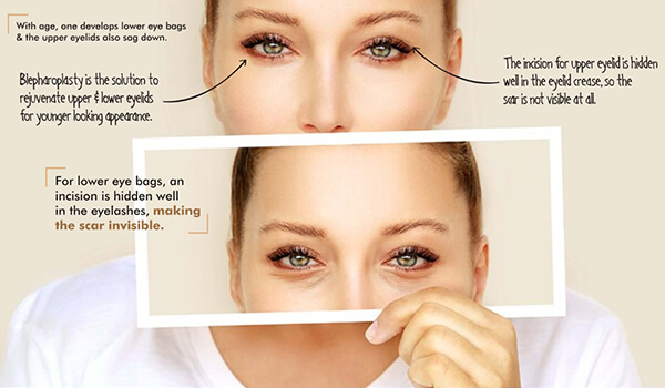 The risk involved in Blepharoplasty Surgery