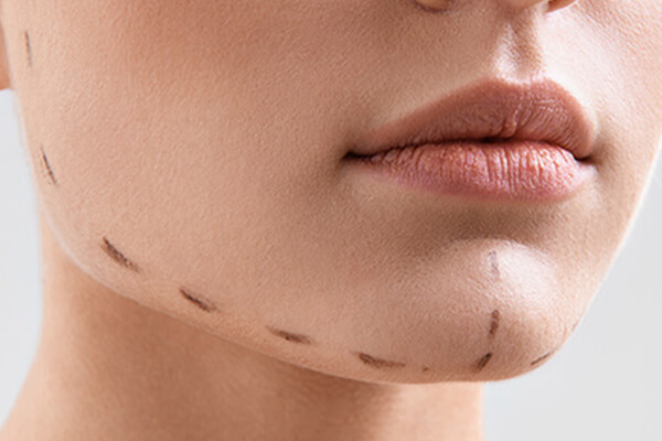 The risk involved in Chin Augmentation