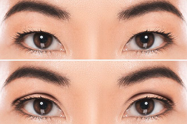 The risk involved in Double Eyelid Surgery