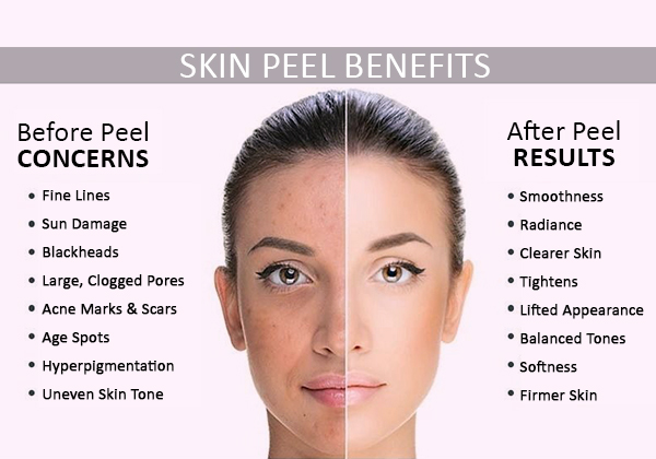 The risk involved in chemical peels