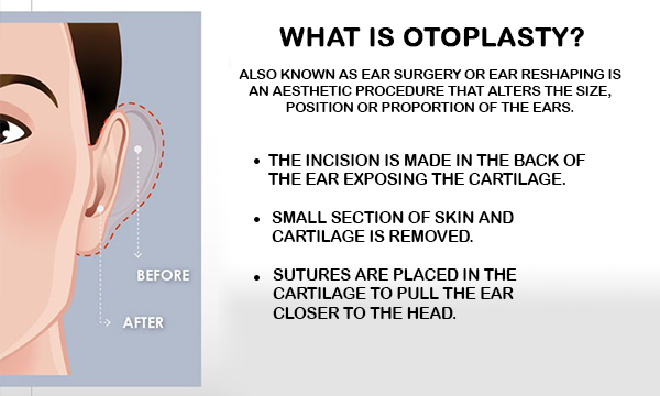 Otoplasty Surgery Cost in Delhi