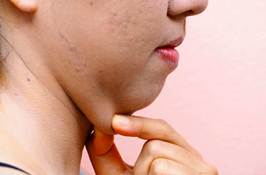 removal-of-double-chin