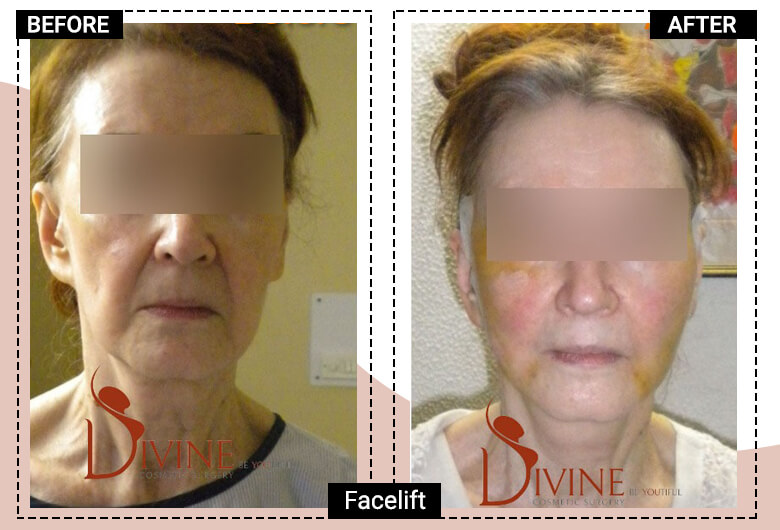 what is facelift surgery