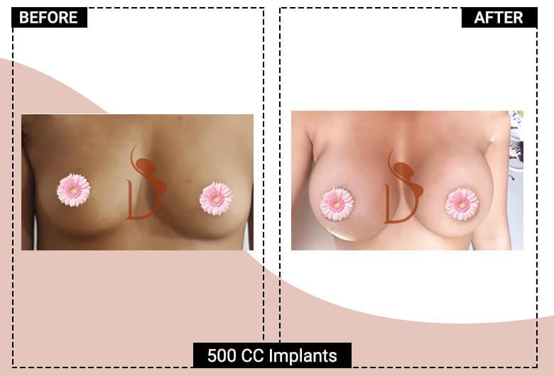 Breast Implant before after