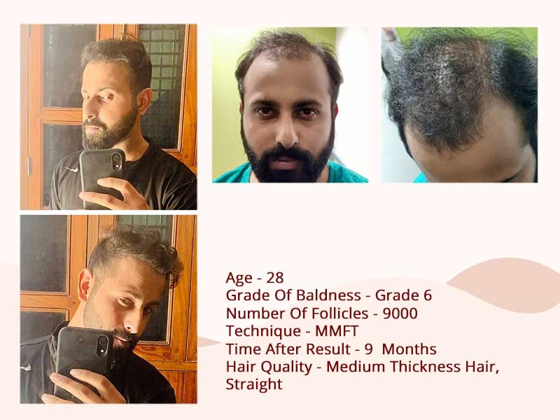 Hair transplant after before - MMFT Technique
