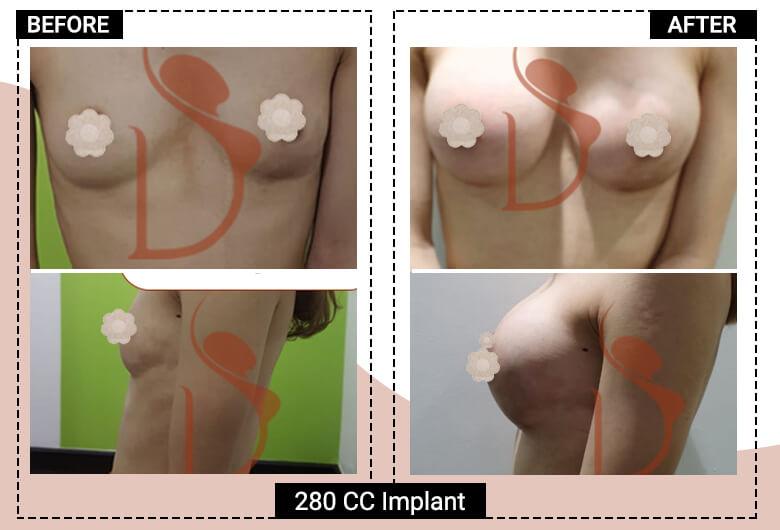 280cc breast implant surgery in delhi