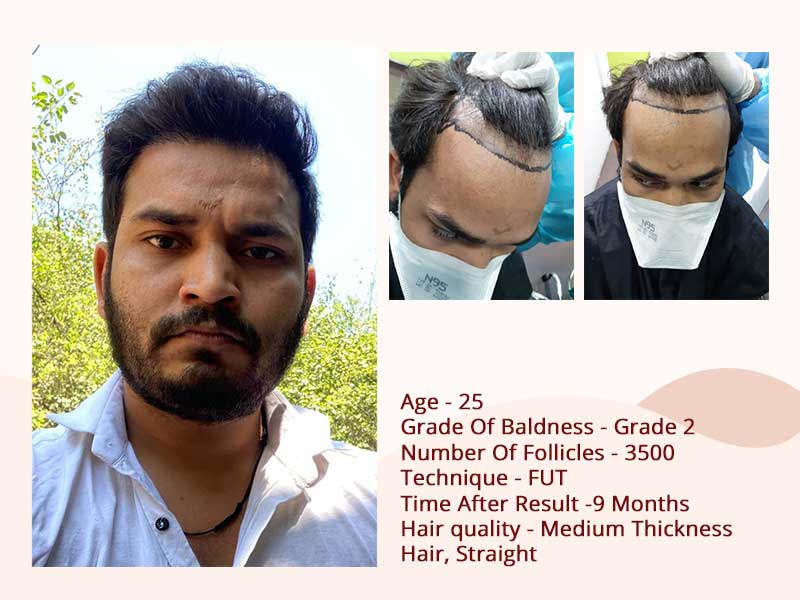 Hair transplant after before - FUT Technique