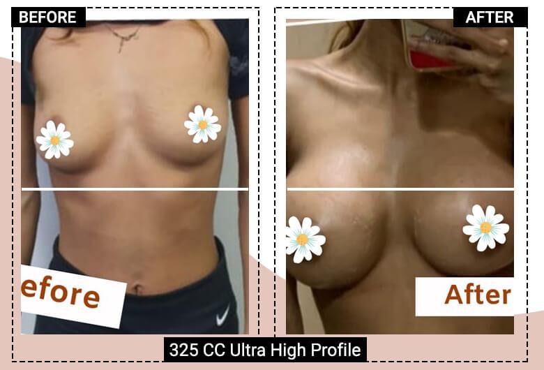 325cc Ultra high profile breast implant surgery delhi