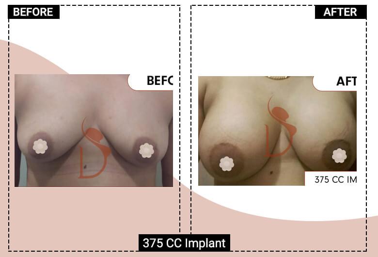 375cc breast implant surgery