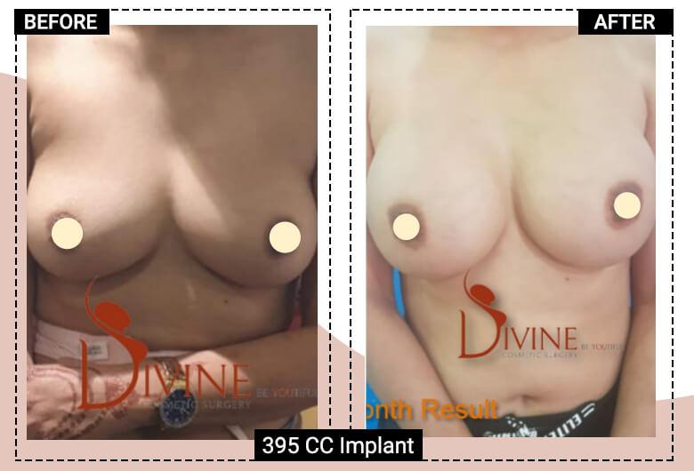 395cc breast implant surgery