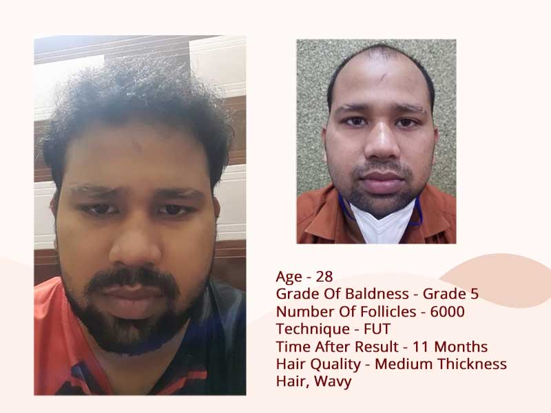 Hair transplant after before - FUT Technique