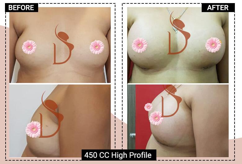 450 CC High profile breast implant