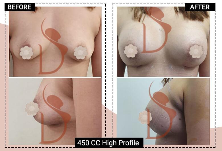 450cc high profile breast implant surgery in delhi