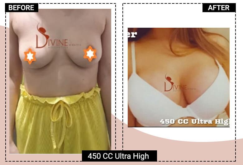 450cc ultra high profile breast implant
