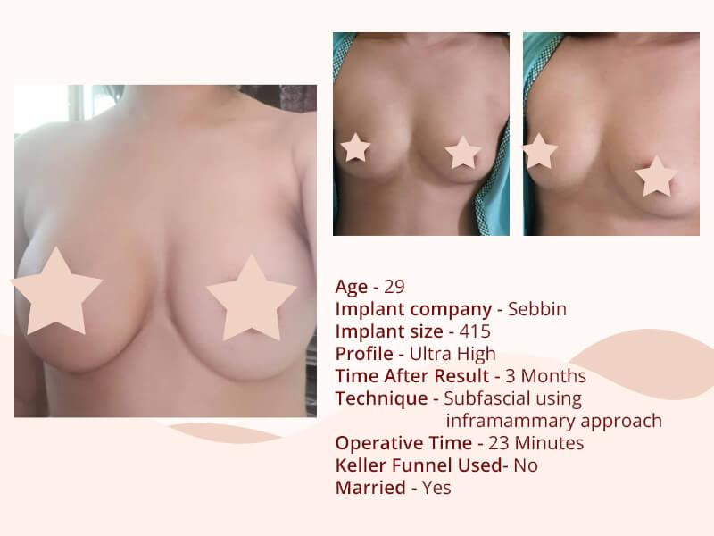 Breast Implant before after