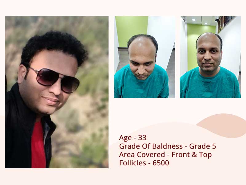 Hair transplant after before